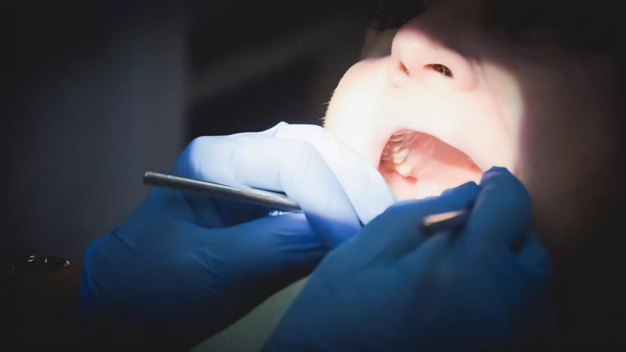 В Челнах у женщины почти сгнила нижняя челюсть из-за страха стоматологов
